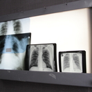 Кто в ВКО чаще болеет раком лёгких, рассказали медики