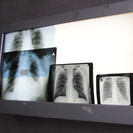 ШҚО-да туберкулезге шалдыққандар саны 10,1%-ға азайды