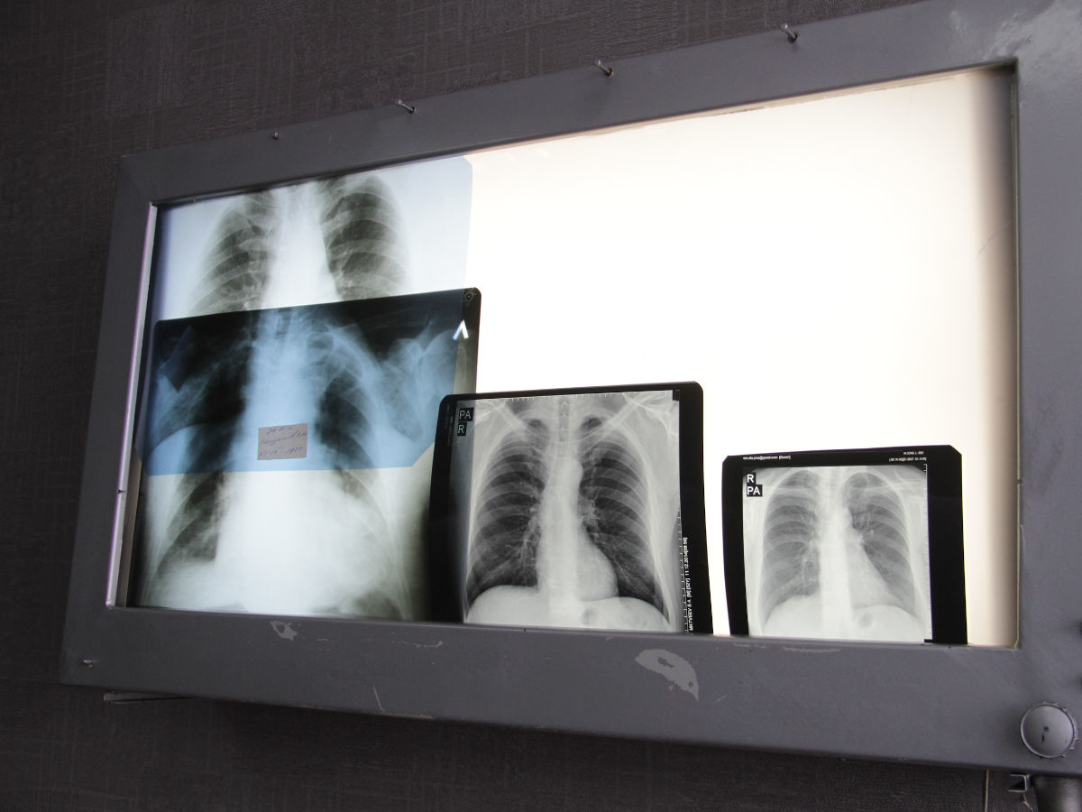 ШҚО-да туберкулезге шалдыққандар саны 10,1%-ға азайды