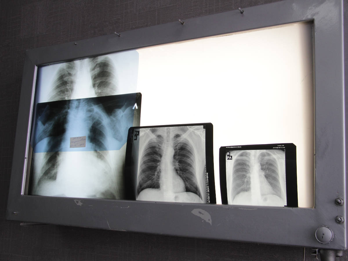 Алтай ауданында туберкулезден өлім-жітім 66%-ға азайды